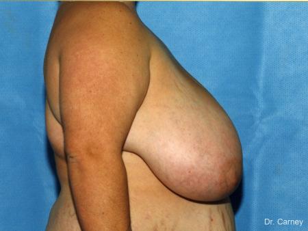 Virginia Beach Breast Reduction 1232 - Before and After Image 2