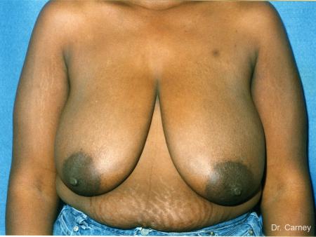 Virginia Beach Breast Lift 1189 - Before Image 1