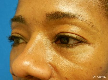 Virginia Beach Eyelid Lift 1130 - After Image 2