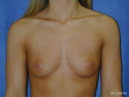 Virginia Beach Breast Augmentation 1080 - Before and After Image 3