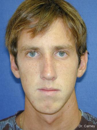 Virginia Beach Rhinoplasty 1219 - After Image 2