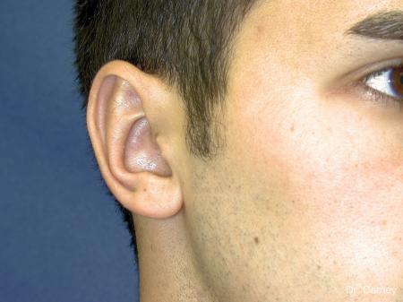 Virginia Beach Otoplasty Earlobe Repair 1222 - After Image 3