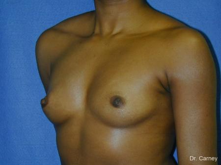Virginia Beach Breast Augmentation 1085 - Before Image 2