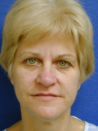 Virginia Beach Facelift 1346 - Before Image 1