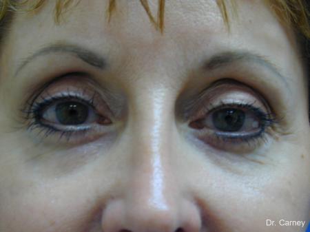 Virginia Beach Eyelid Lift 1131 - After Image 1