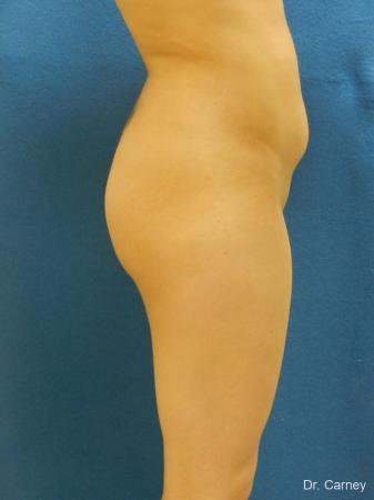 Virginia Beach Brazilian Butt Lift 1221 - Before Image 3