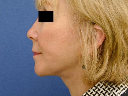 Virginia Beach Laser Skin Resurfacing Face 1263 - After Image 4