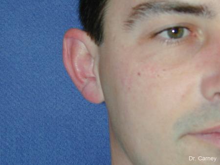 Virginia Beach Otoplasty Earlobe Repair 1237 - Before and After Image 4