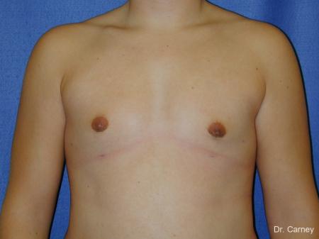 Virginia Beach Gynecomastia - After Image 1