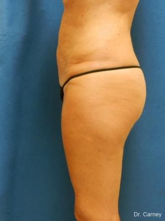 Virginia Beach Liposuction 1279 - After Image 5