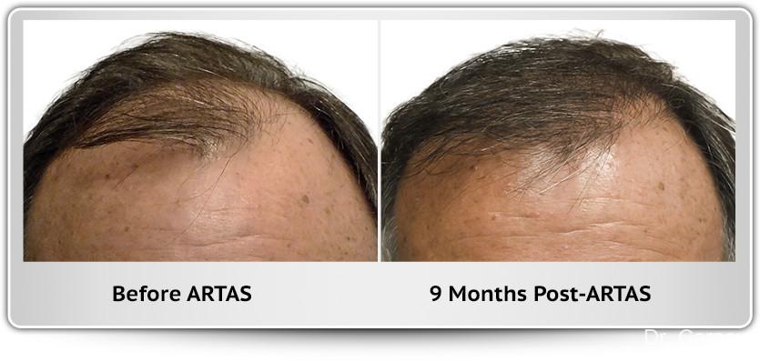 Hair Transplantation: Patient 12 - Before and After 