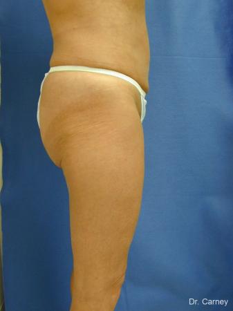 Virginia Beach Liposuction 1213 - After Image 5