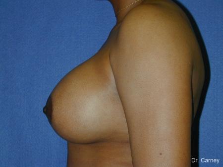 Virginia Beach Breast Augmentation 1091 - After Image 2