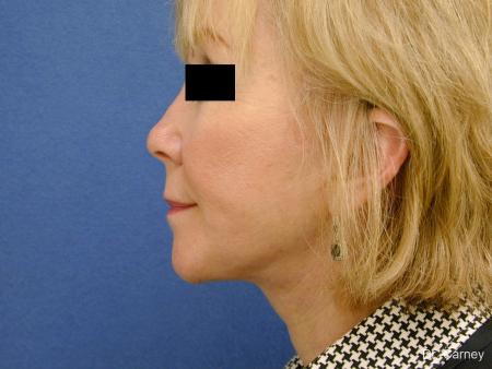 Virginia Beach Facelift 1262 - After Image 5