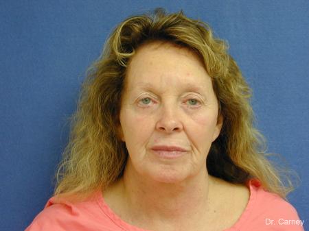 Virginia Beach Facelift 1127 - Before and After Image 3