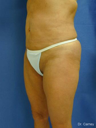 Virginia Beach Liposuction 1213 - After Image 1