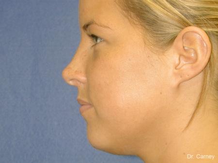 Virginia Beach Rhinoplasty 1218 - After Image 3