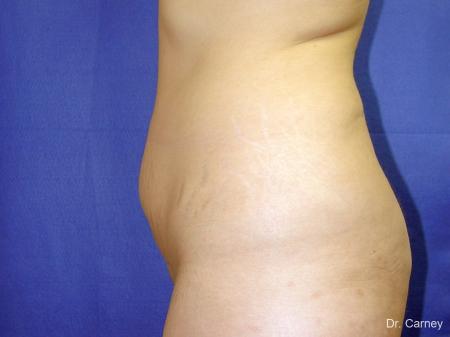 Tummy Tuck: Patient 1 - Before Image 3