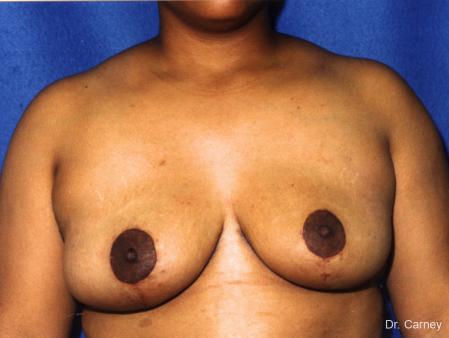 Virginia Beach Breast Reduction 1231 - After Image 1