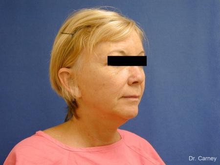 Virginia Beach Facelift 1262 - Before Image 2