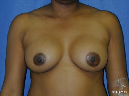 Virginia Beach Breast Augmentation 1091 - After Image 1