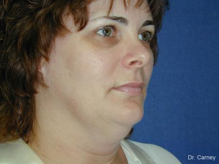 Virginia Beach Facelift 1136 - Before Image 1