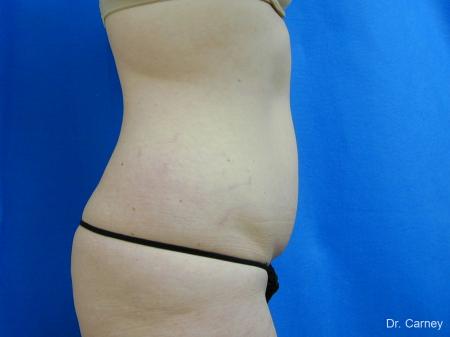 Virginia Beach Tummy Tuck 1251 - Before and After Image 3