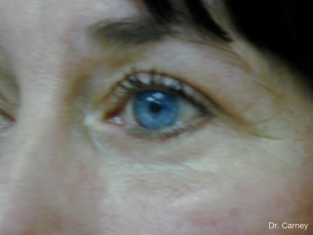 Virginia Beach Eyelid Lift 1139 - After Image 2