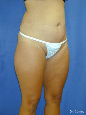 Virginia Beach Liposuction 1284 - After Image 5