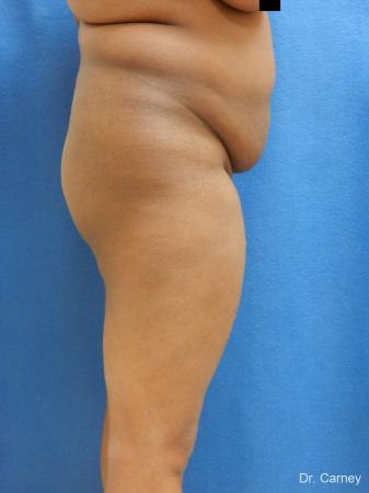 Brazilian Butt Lift: Patient 5 - Before and After Image 5