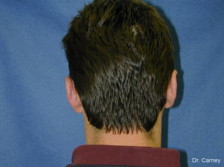 Virginia Beach Otoplasty Earlobe Repair 1237 - After Image 1