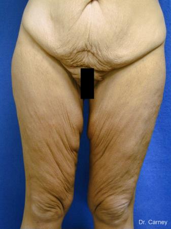 Virginia Beach Thigh Lift 1252 - Before Image 1