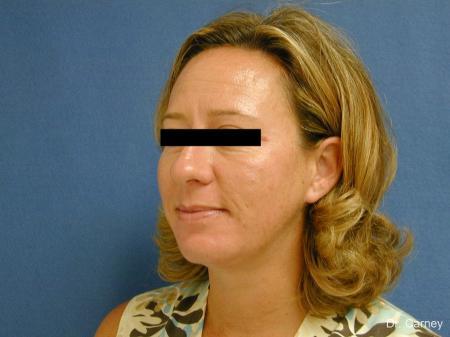 Virginia Beach Neck Lift 1267 - After Image 2
