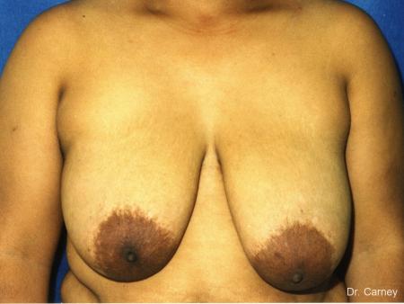 Virginia Beach Breast Reduction 1231 - Before Image 1