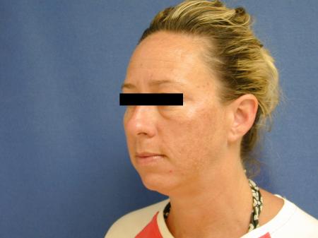 Virginia Beach Neck Lift 1267 - Before Image 2