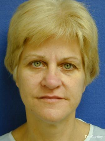 Virginia Beach Brow Lift 1345 - Before Image 2