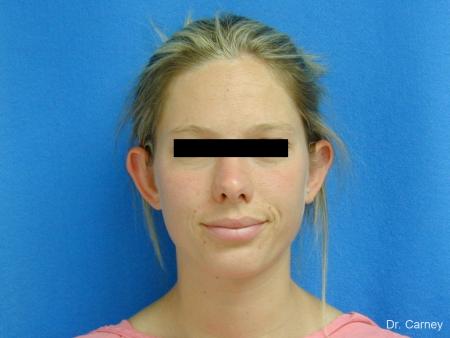 Virginia Beach Otoplasty Earlobe Repair 1223 - Before Image 2