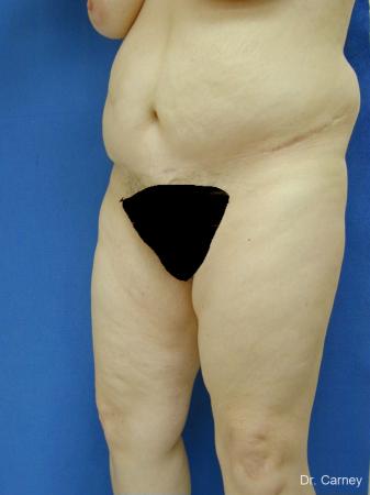 Virginia Beach Tummy Tuck 1250 - After Image 1
