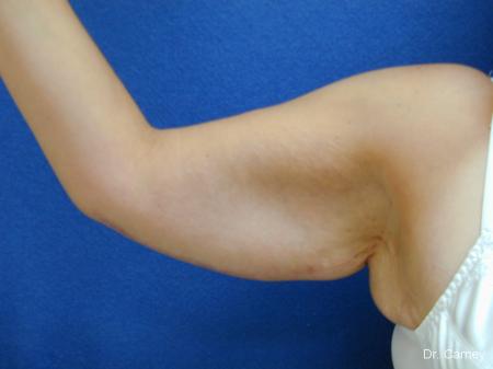 Virginia Beach Brachioplasty 1140 - After Image 1