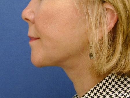 Virginia Beach Neck Lift 1264 - After Image 1