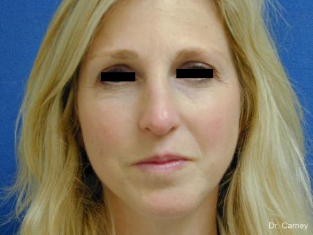 Virginia Beach Rhinoplasty 1343 - Before Image 1