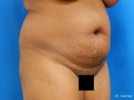 Abdominoplasty: Patient 1 - Before Image 2