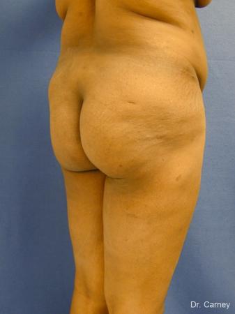 Virginia Beach Brazilian Butt Lift 1220 - Before Image 2