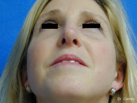Virginia Beach Rhinoplasty 1343 - After Image 2