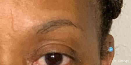 Microblading: Patient 2 - Before Image 1