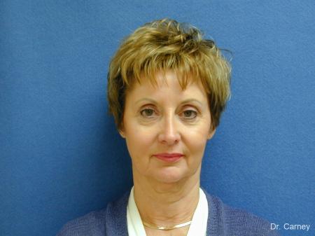 Virginia Beach Facelift 1132 - Before Image 1