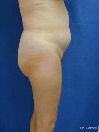 Virginia Beach Liposuction 1213 - Before and After Image 5