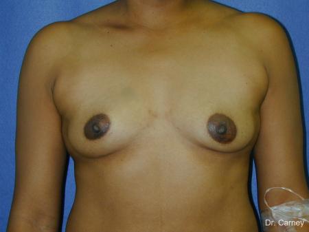 Virginia Beach Breast Augmentation 1091 - Before Image 1