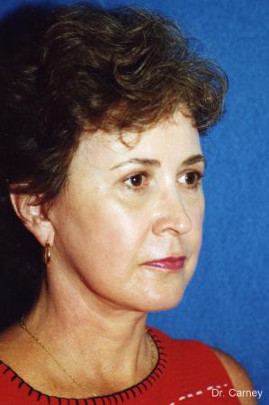 Virginia Beach Laser Skin Resurfacing - Face 1259 - After Image 1
