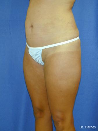 Virginia Beach Liposuction 1284 - After Image 2